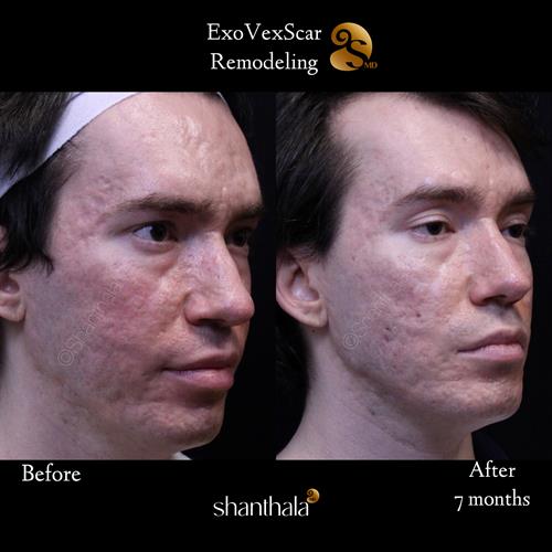 Acne Scar treatment by Dr. Shanthala