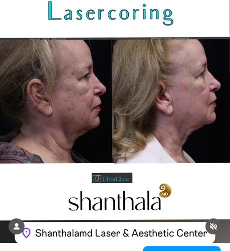 LaserCoring Full face & Neck: FaceLift alternative