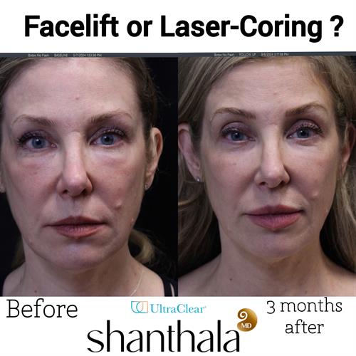 LASERCORING FACELIFT