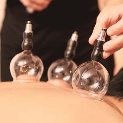 Cupping is a therapy involving the placement of glass, plastic, or bamboo cups on the skin with a vacuum. The therapy is used to relieve what is called “stagnation” in Traditional Chinese Medicine terms and is used in the treatment of respiratory diseases such as the common cold, pneumonia and bronchitis. Cupping is also used to treat back, neck, shoulder, and other musculoskeletal pain.