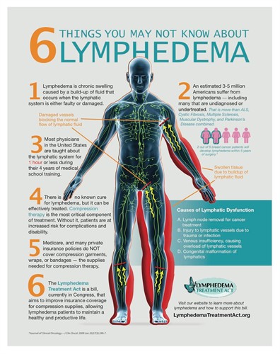 6 things about Lymphedema