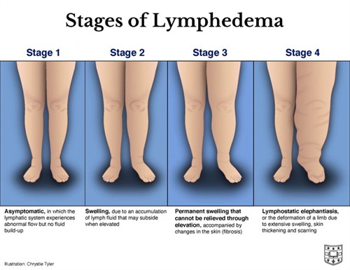 Stages of Lymphedema