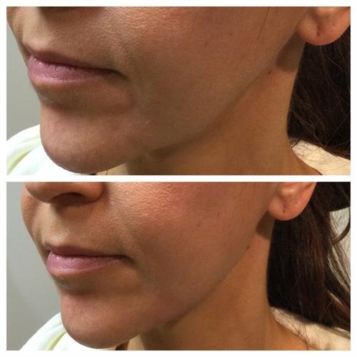 Jawline enhancement with Juvederm Vollure filler Jawline enhancement with Juvederm Vollure filler