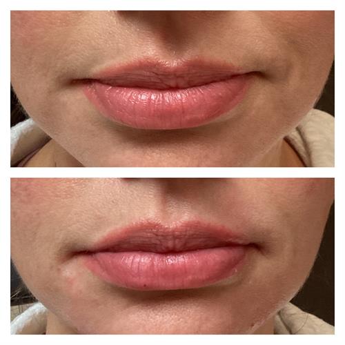 Lip augmentation Lip augmentation