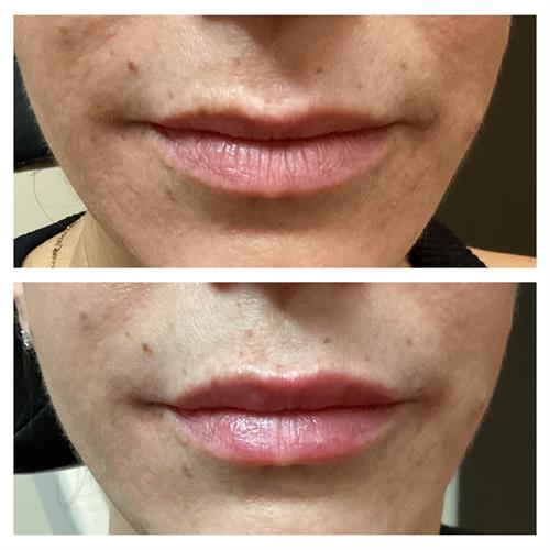 Winter lip hydration with Skinvive Winter lip hydration with Skinvive