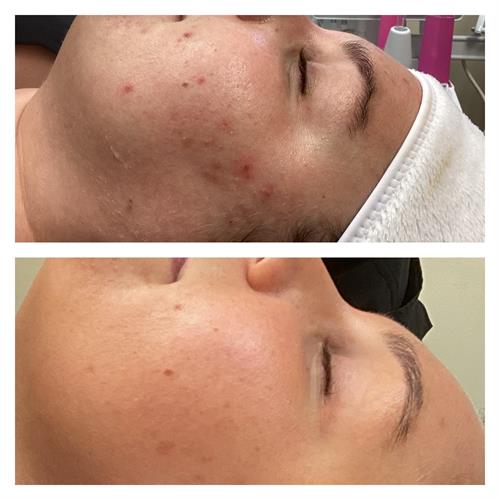 DiamondGlow facial treatment DiamondGlow facial treatment