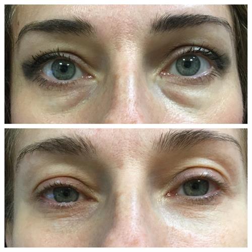 Rested Relaxed under eye - Filler Rested Relaxed under eye - Filler