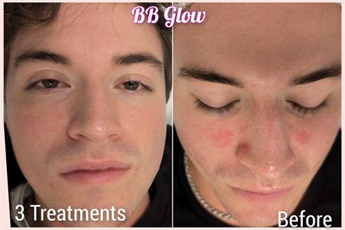 Rosacea correction with BB Glow Semi Permanent Foundation Treatments