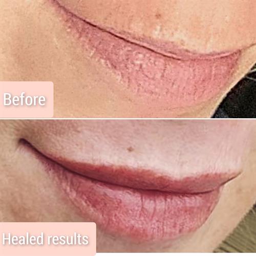 Healed Lip Blush results showing correction of loss of pigment making lips appear full and more youthful