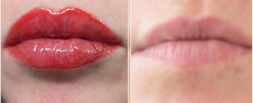 Fresh Lip Blush tattoo that uses full vermillion area to create fuller looking lips and camouflage scarring