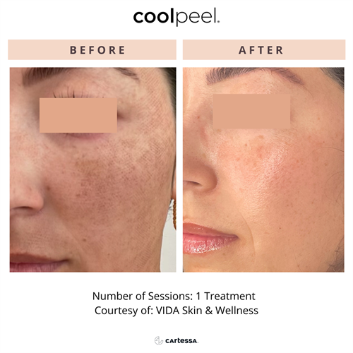 Coolpeel Results Coolpeel Results