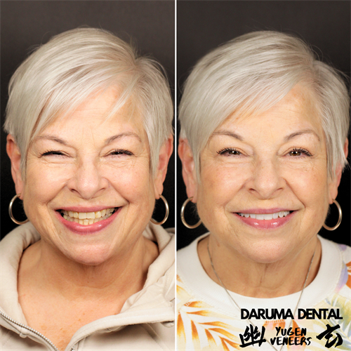 Yugen Veneers - A Marshall Hanson Method