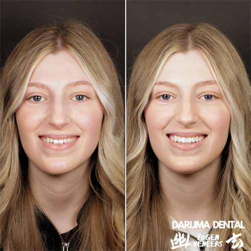 Yugen Veneers - A Marshall Hanson Method