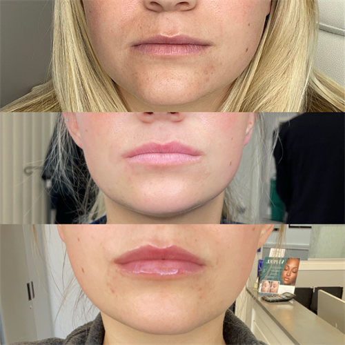 Lip Filler Results 