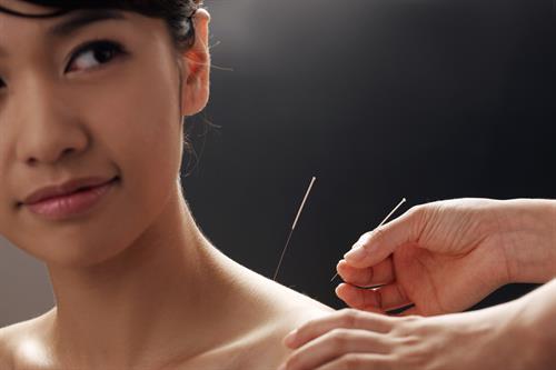 DRY NEEDLING ( accupuncture) TREATMENT FOR PAINFUL CONDITIONS DRY NEEDLING ( accupuncture) TREATMENT FOR PAINFUL CONDITIONS