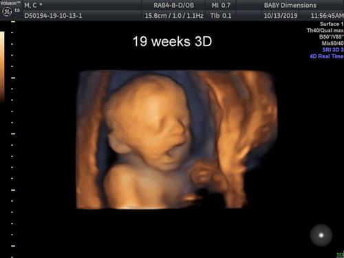 19 week baby in 3D imaging