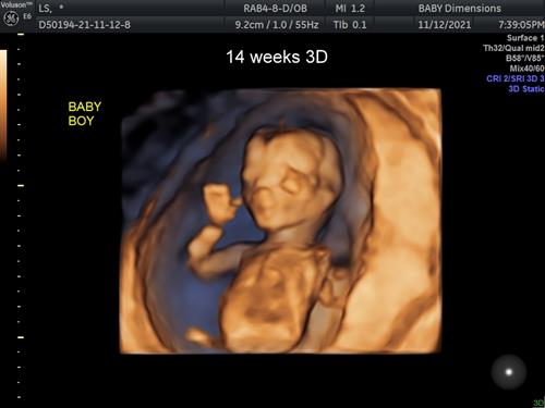 14 week baby in 3D imagingm 4DLive is watching them moving in motion