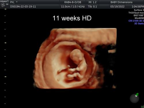 11 weeks baby in HD imaging