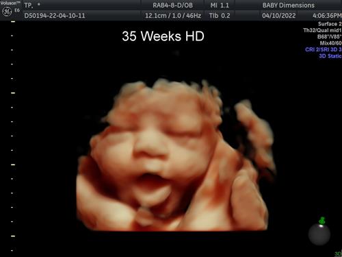 35 week Baby in HD imaging