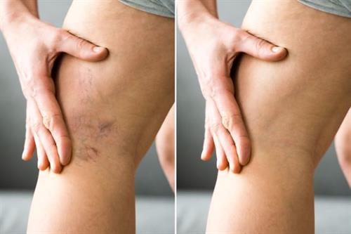 before and after sclerotherapy 