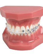 Gallery Image Braces_model.jpg