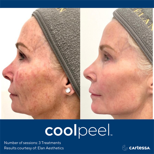 Gallery Image coolpeel3treatmentsface.png