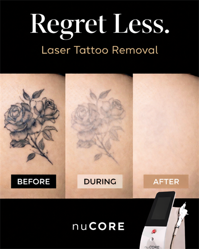 Gallery Image tattooremoval.png