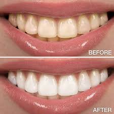 Teeth Whitening