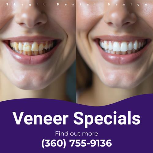 Veneer Special