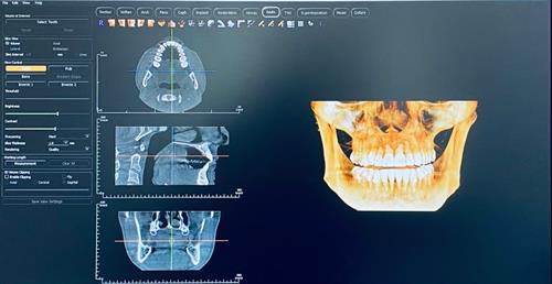 CBCT Scan 