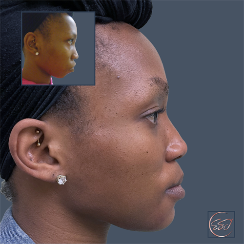 Profile Enhancement with Chin Contouring