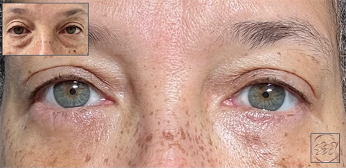 Refeshing Transformation with Lower Eyelid Contouring
