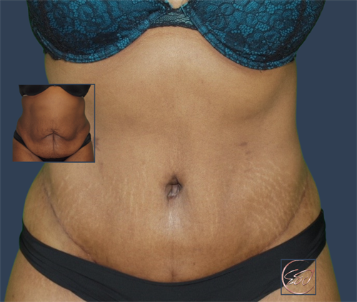 Body Contouring with a Tummy Tuck