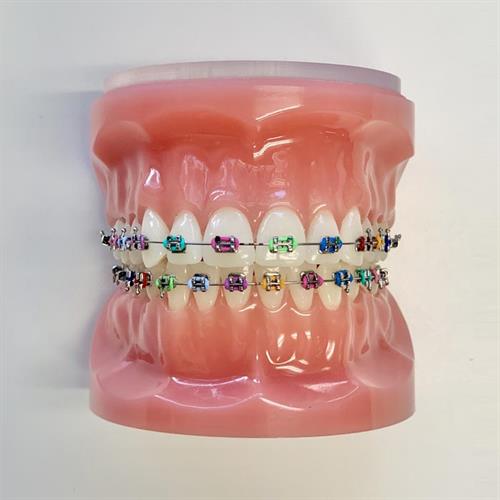 metal-braces-colors-artemis-smiles-orthodontics-atlanta-ga