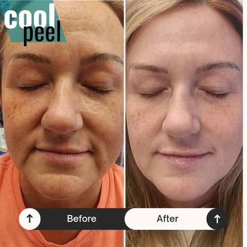 Discover the Power of Non-Ablative Laser Therapy! Our CoolPeel offers remarkable benefits:  Stimulate Collagen Growth, Restore Skin Radiance,  Minimize Fine Lines, and Helps Reduce Under Eye Bags. Schedule your appointment today and unlock a new level of confidence! 