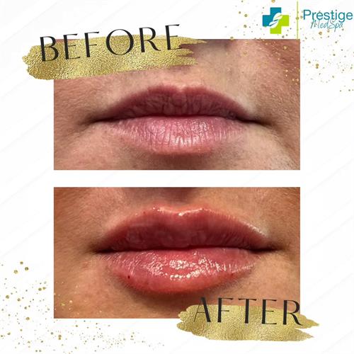Transforming smiles one lip filler at a time! Before and after, witness the magic of fuller, more defined lips. Consult with our experts for your perfect pout!