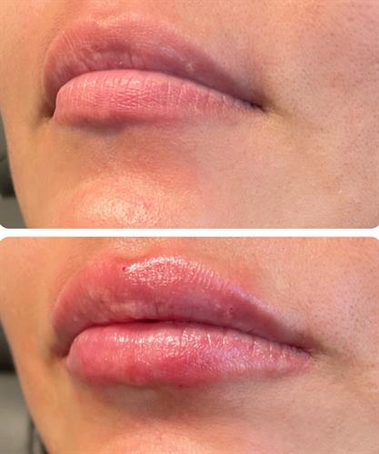 Lip Filler Before & After 