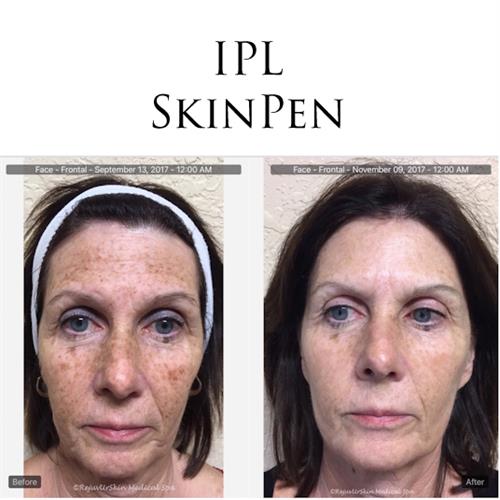 IPL & SkinPen - Real people, real results