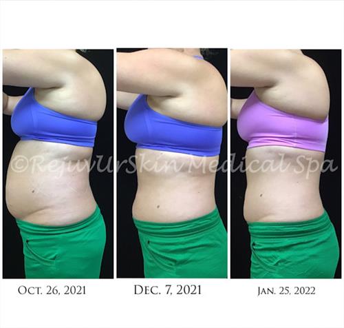 TruSculpt ID - Real people, real results