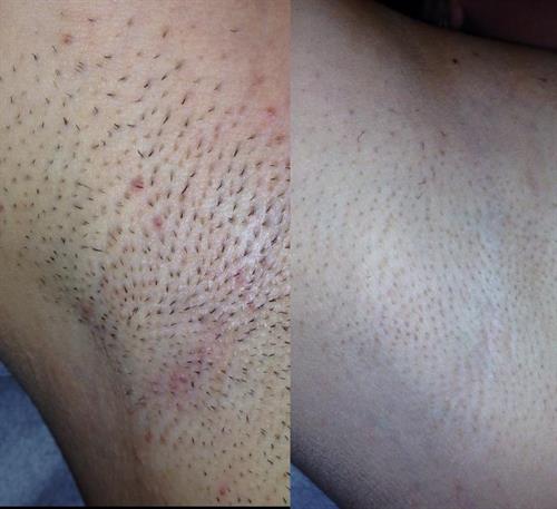 PERMANENT HAIR REDUCTION before and after 3 treatments UNDERARMS