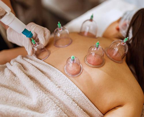 Gallery Image 16554-cupping-therapy.jpg