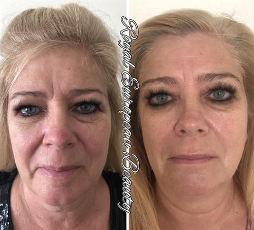 Facial Tissue Stimulation Therapy Facial Tissue Stimulation Therapy