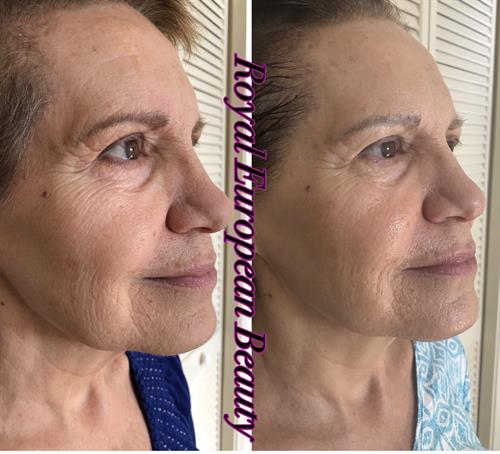 Facial Tissue Stimulation Therapy Facial Tissue Stimulation Therapy