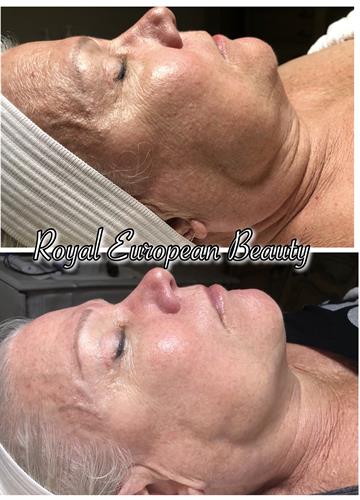 Facial Tissue Stimulation Therapy Facial Tissue Stimulation Therapy