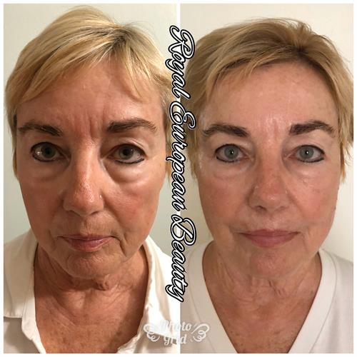 Facial Tissue Stimulation Therapy Facial Tissue Stimulation Therapy