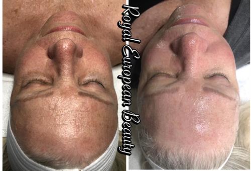 Facial Tissue Stimulation Therapy Facial Tissue Stimulation Therapy
