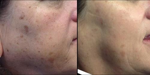 Before & after Alexandrite Laser Spot Treatment