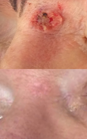 Before & after a shaved biospy for skin cancer