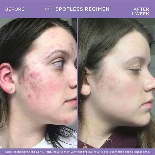 SPOTLESS is an easy 2-step regimen for teen and young adult acne. 100% of people see improvement in the first week!
