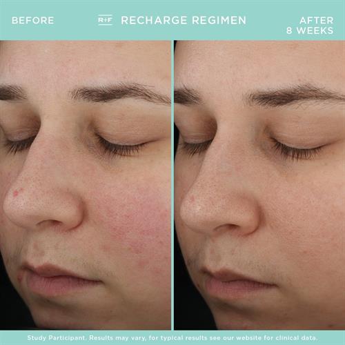 Our RECHARGE regimen addresses the needs of the 20-somethings who don't yet need anti-aging skincare. Addresses dullness, rehydrates, and nourishes skin to keep it healthy and delay the signs of aging.